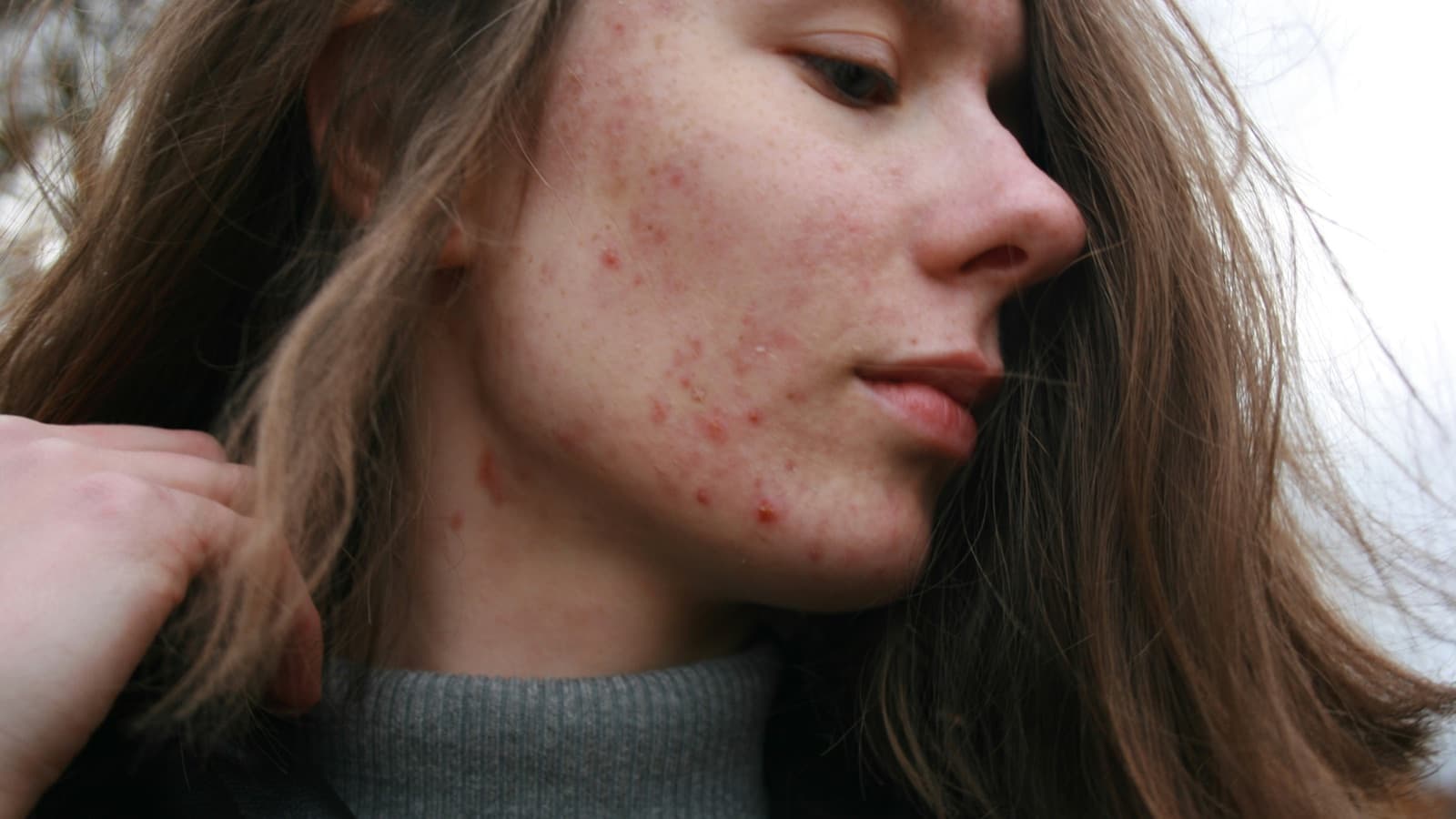 Adult-onset eczema — what to try before jumping to biologics