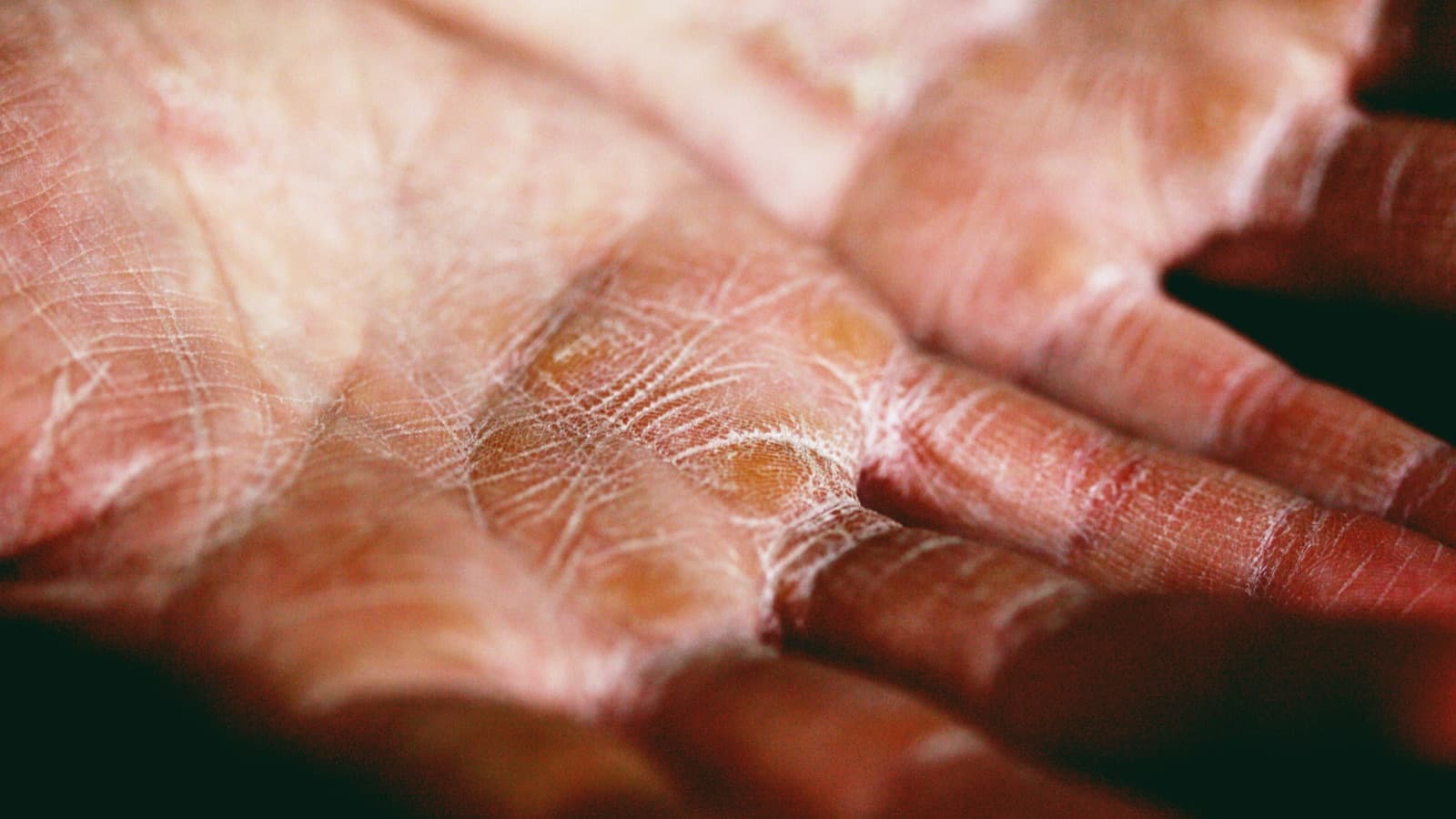 Hives that won't go away after 6 weeks — when Zyrtec isn't enough